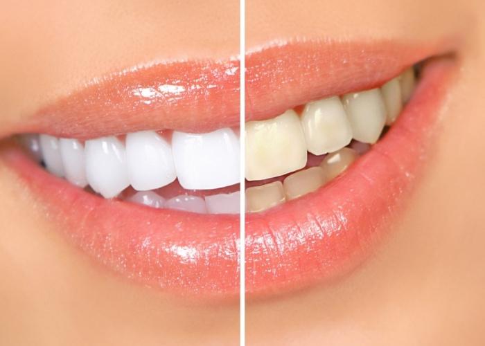 과산화수소를 사용하는 특별한 방법 : 치아 미백